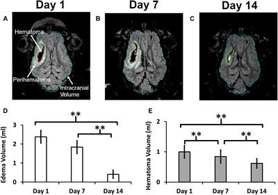Serial Metabolic Evaluation of Perihematomal Tissues in the Intracerebral Hemorrhage Pig Model